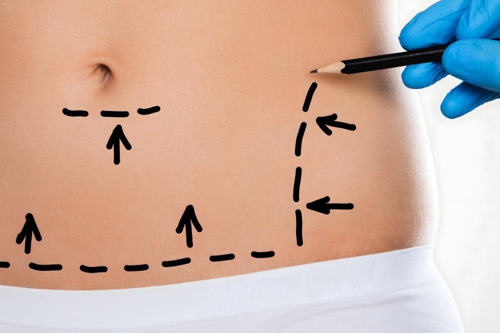 Cuidados pre y post liposucción: maximice sus resultados