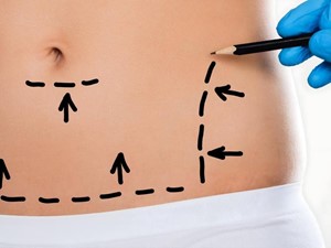 Cuidados pre y post liposucción: maximice sus resultados