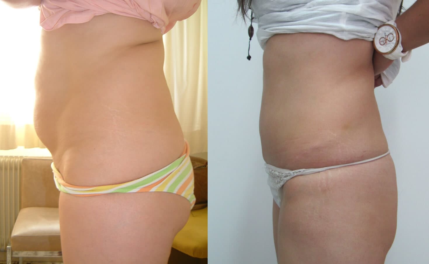 Abdominoplastia/dermolipectomía  antes/después