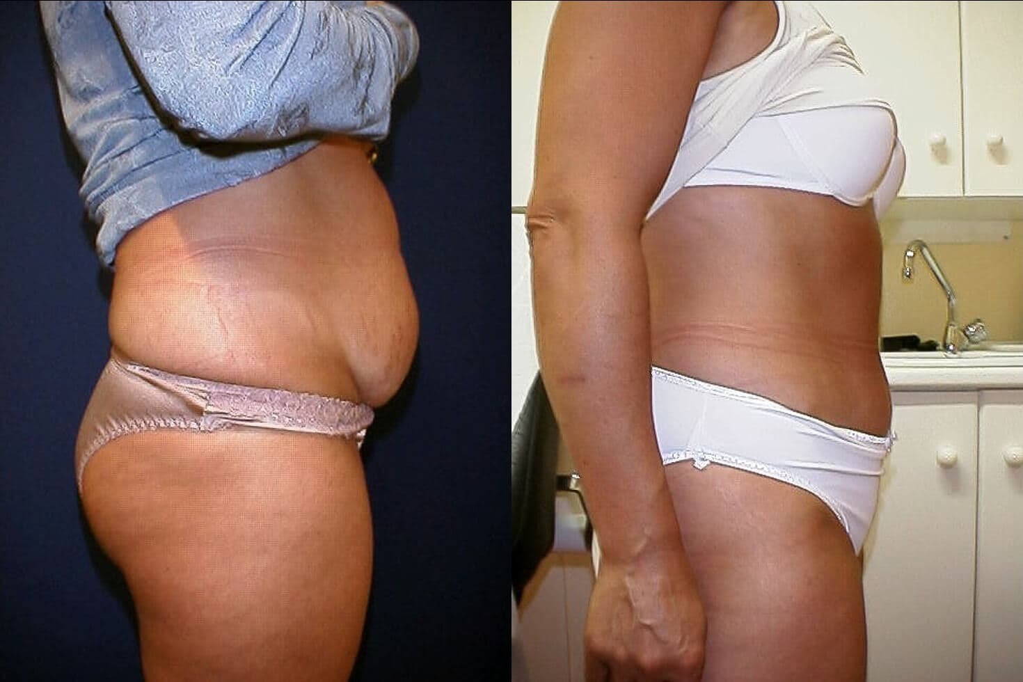 Abdominoplastia/dermolipectomía  antes/después