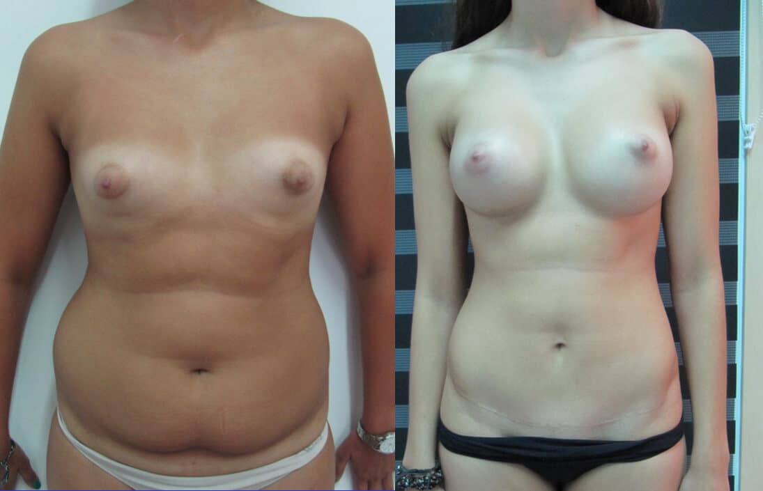 Abdominoplastia/dermolipectomía  antes/después