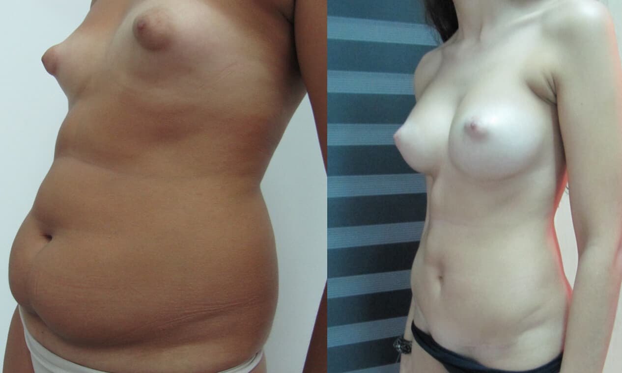 Abdominoplastia/dermolipectomía  antes/después