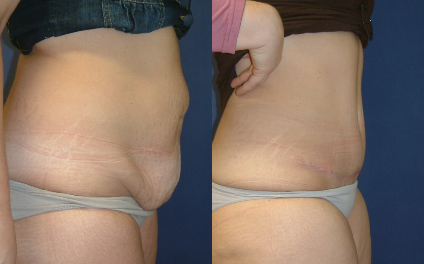 Abdominoplastia/dermolipectomía  antes/después