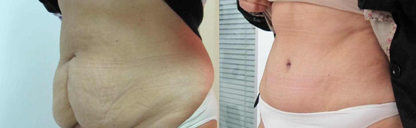 Abdominoplastia/dermolipectomía  antes/después