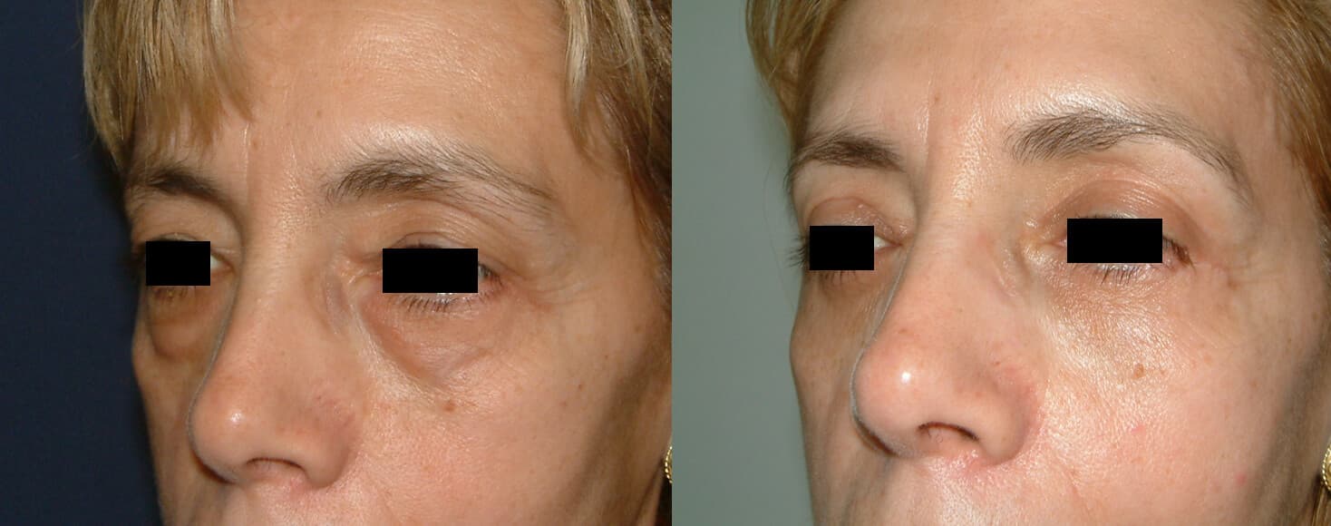 Blefaroplastia antes/después