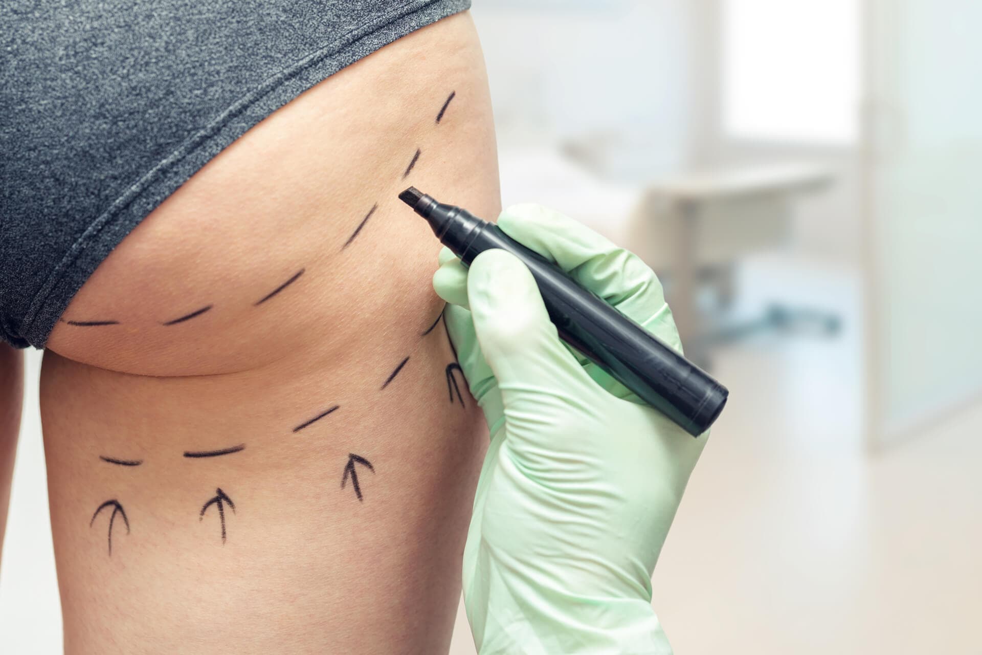 Lipoaspiración o lipoescultura